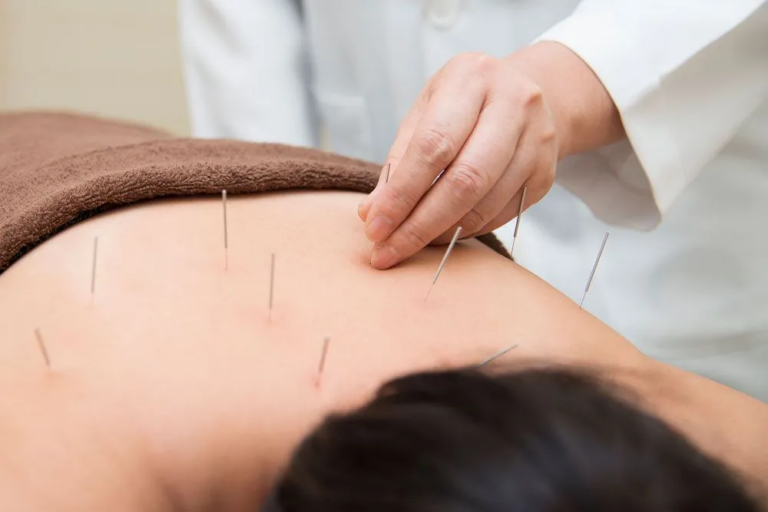 TCM Acupuncture in Singapore: A Path to Holistic Healing